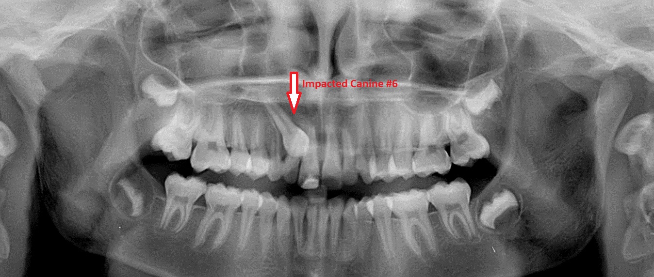 What Causes Impacted Canines